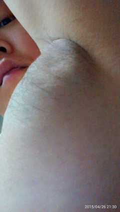 怀孕长副乳怎么办