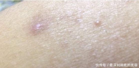 背上的痘痘是啥