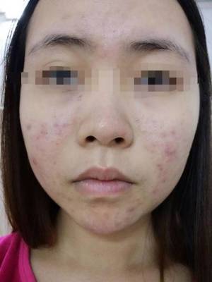 痘痘泛红是怎麽回事