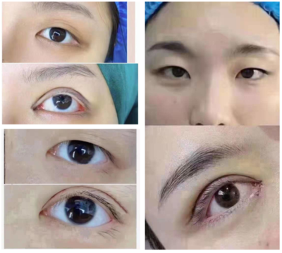 纳米双眼皮后总磨眼睛