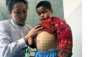 小孩肝大是怎么回事