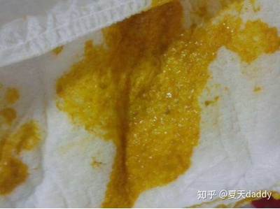 新生儿蛋花样大便