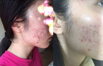 两个星期痘痘好不了