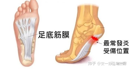 足底筋膜炎怎么治疗