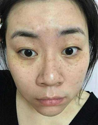 开塞露真的能祛斑吗