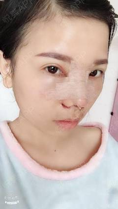 取耳软骨隆鼻疼吗