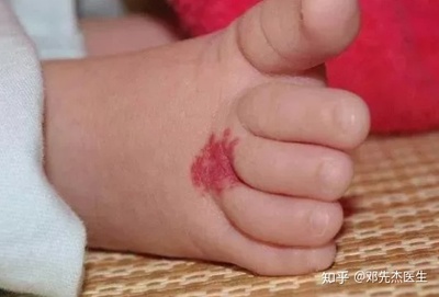 脸上血管瘤怎么治疗