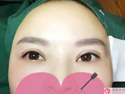 割了双眼皮需要注意事项