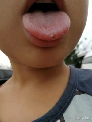 得了口腔白斑怎么治疗