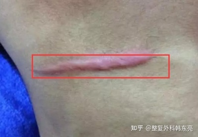 疤痕放疗