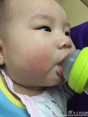 宝宝湿疹可以洗脸吗