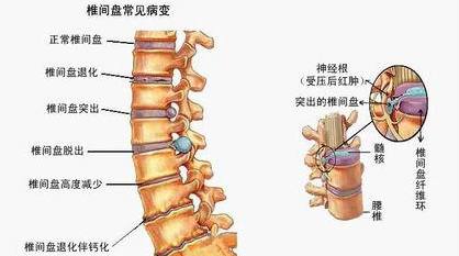 腰间狭窄是怎么回事