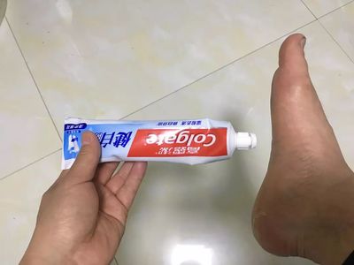 痘痘抹牙膏