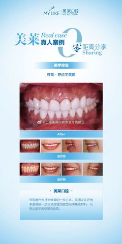 牙齿矫正上海美莱领先