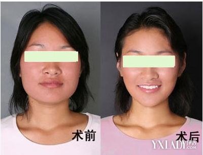 瘦脸针能瘦脸么