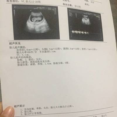 胎儿心率快