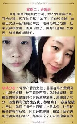怀孕后长斑是什么原因