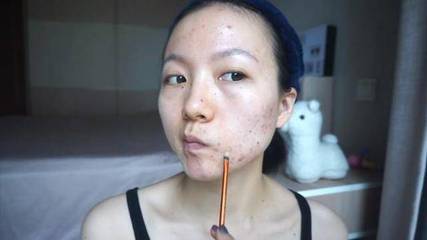 满脸痘痘用什么遮瑕膏
