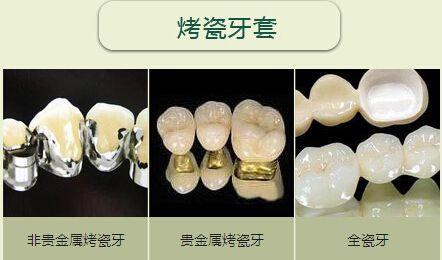 贵金属烤瓷牙的危害