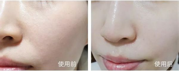 痘痘肌可以用茶叶敷脸吗