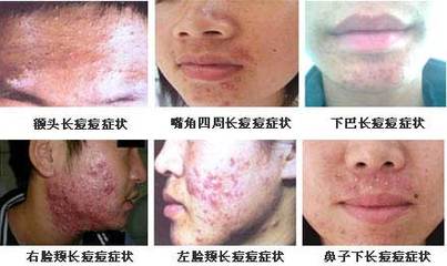 右脸长痘痘是怎么回事啊
