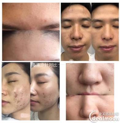微针炎症痘痘