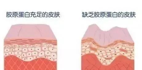 痘痘是胶原蛋白吗