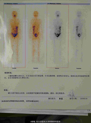 甲状腺碘扫多少钱