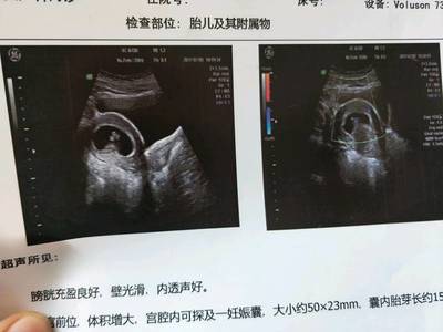 怀孕8周胎儿图片欣赏
