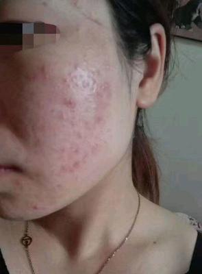 痘痘方法的博客