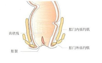 怎么治疗肛裂