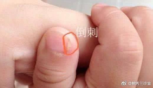 宝宝手倒刺缺什么营养