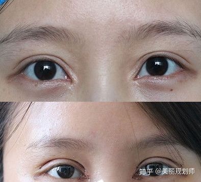 八大处靳小雷内双眼皮
