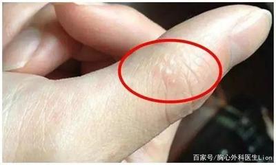 右边侧面长痘痘