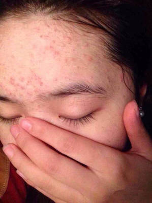女孩子脸上有痘痘