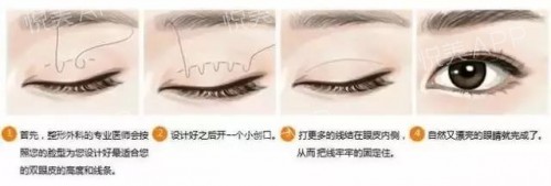 全切双眼皮和埋线哪个好