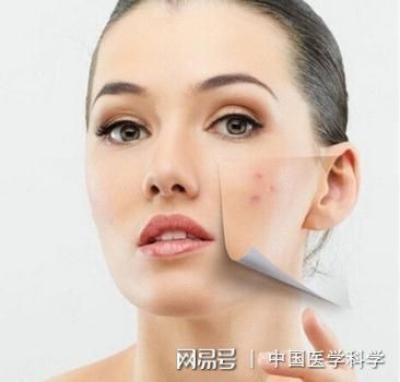 长痘痘痤疮不能吃什么东西