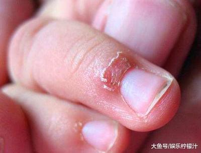 手指上起皮是怎么回事