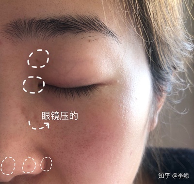 药水点痣后的恢复过程