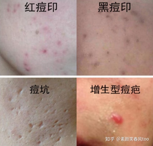 痘印和痘疤