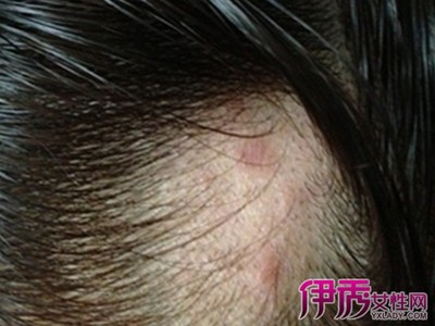头皮炎怎么治疗