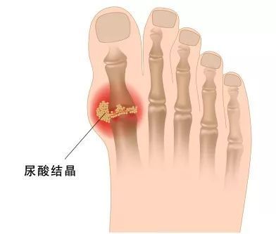脚底板热是怎么回事