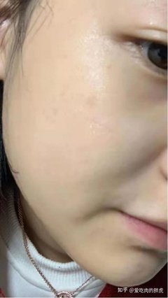 什么水乳适合油皮痘痘男