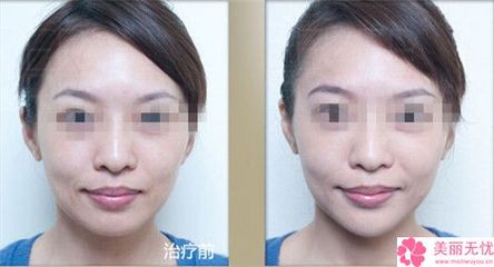 整形瘦脸针注射多少钱