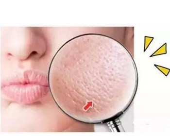 如何使毛孔变细腻