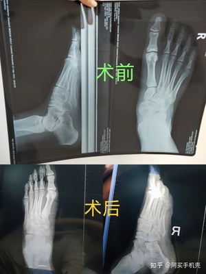 副舟骨怎么治疗最好