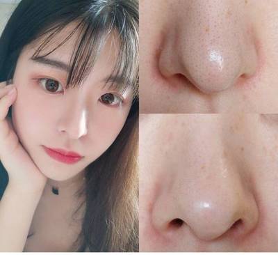 鼻子两边毛孔粗大是什么原因