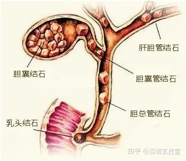 胆结石该怎么治疗