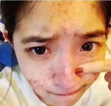 痘痘脸可以护肤品吗