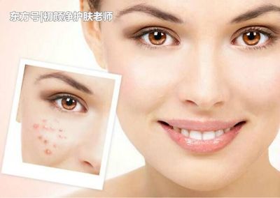 为什么痘痘总是反反复复